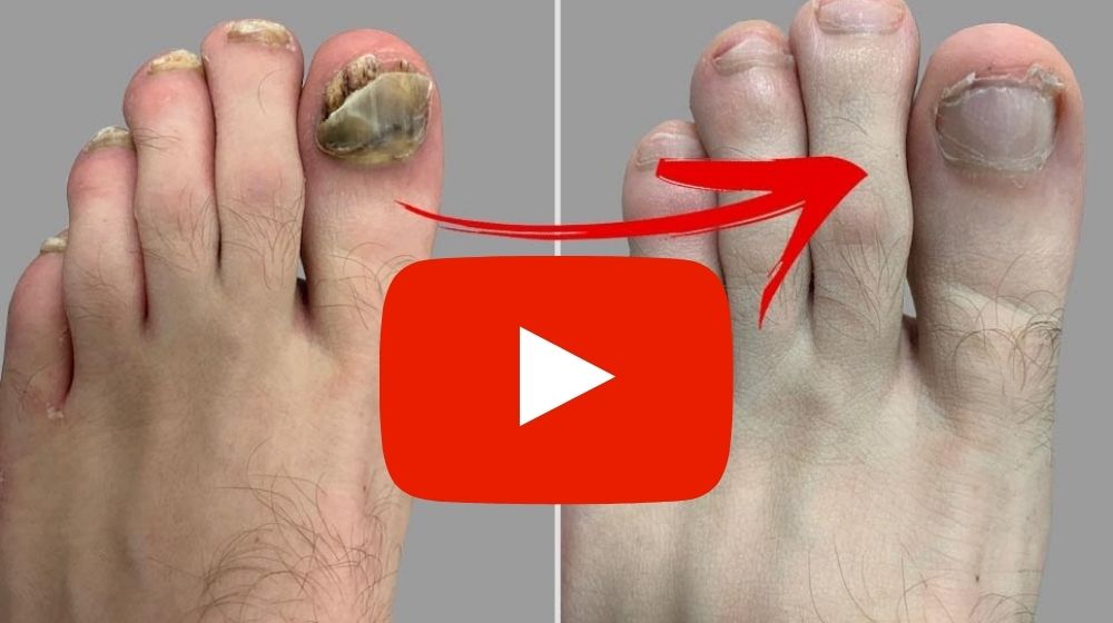 Toenail Fungus